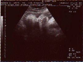 Ultrasound at 33 Weeks